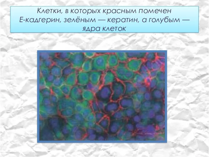 Клетки, в которых красным помечен Е-кадгерин, зелёным — кератин, а голубым — ядра клеток