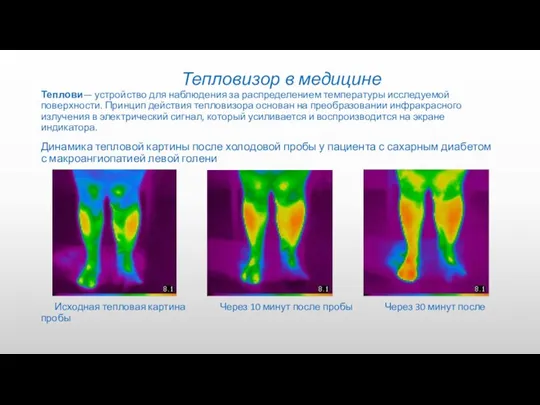 Тепловизор в медицине Теплови— устройство для наблюдения за распределением температуры