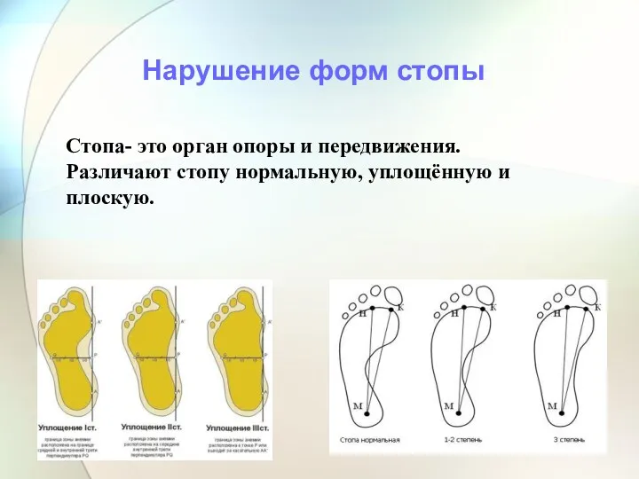 Стопа- это орган опоры и передвижения. Различают стопу нормальную, уплощённую и плоскую. Нарушение форм стопы