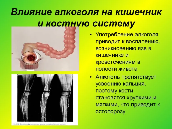 Влияние алкоголя на кишечник и костную систему Употребление алкоголя приводит к воспалению, возникновению