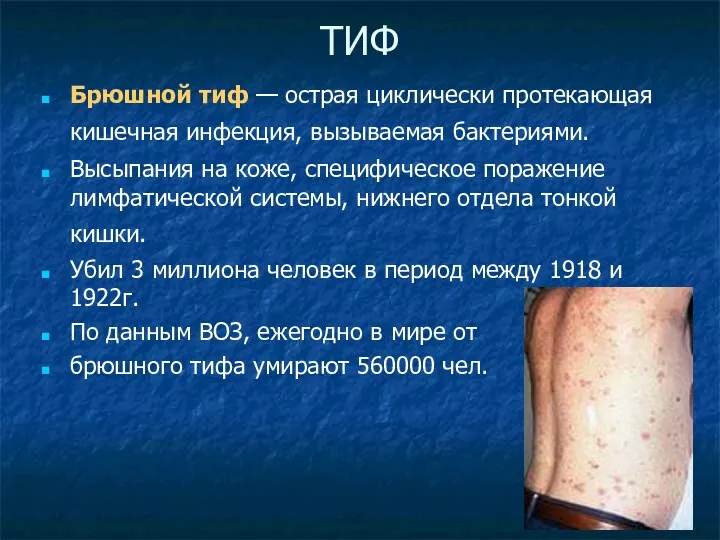 ТИФ Брюшной тиф — острая циклически протекающая кишечная инфекция, вызываемая бактериями. Высыпания на