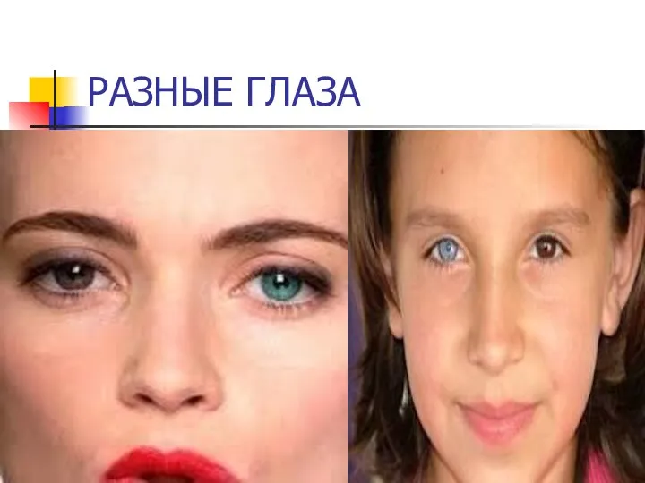 РАЗНЫЕ ГЛАЗА