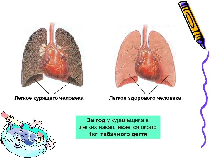 За год у курильщика в легких накапливается около 1кг табачного дегтя