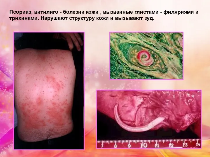 Псориаз, витилиго - болезни кожи , вызванные глистами - филяриями