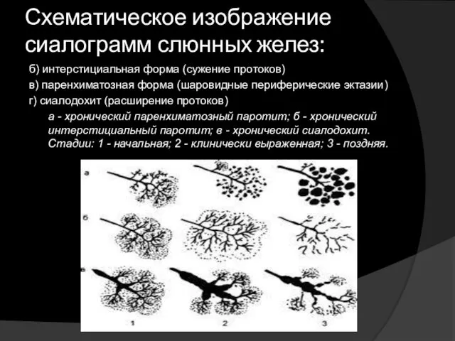 Схематическое изображение сиалограмм слюнных желез: б) интерстициальная форма (сужение протоков)