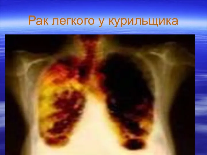 Рак легкого у курильщика