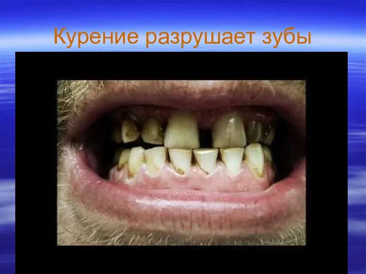 Курение разрушает зубы