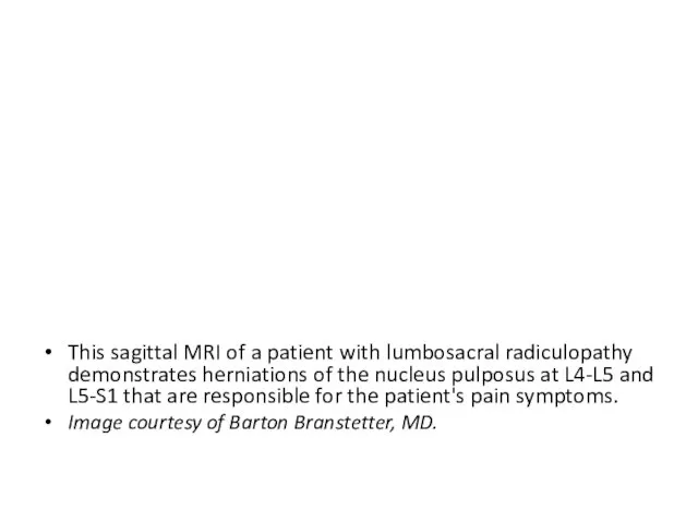 This sagittal MRI of a patient with lumbosacral radiculopathy demonstrates