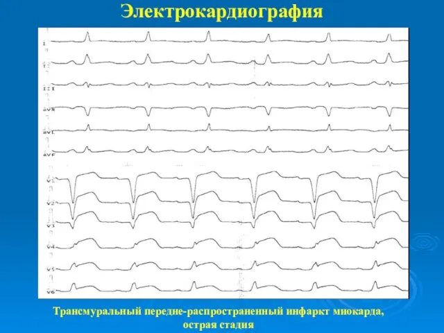 Электрокардиография Трансмуральный передне-распространенный инфаркт миокарда, острая стадия