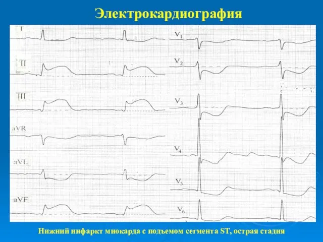Электрокардиография Нижний инфаркт миокарда с подъемом сегмента ST, острая стадия