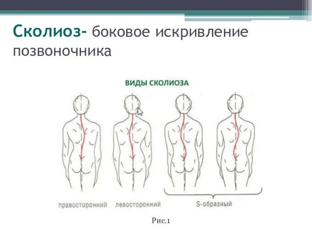 Сколиоз- боковое искривление позвоночника Рис.1