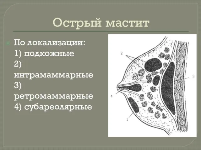 Острый мастит По локализации: 1) подкожные 2) интрамаммарные 3) ретромаммарные 4) субареолярные