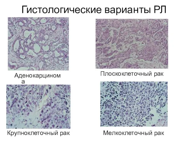 Гистологические варианты РЛ Аденокарцинома Плоскоклеточный рак Крупноклеточный рак Мелкоклеточный рак