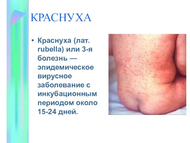 КРАСНУХА Краснуха (лат. rubella) или 3-я болезнь — эпидемическое вирусное