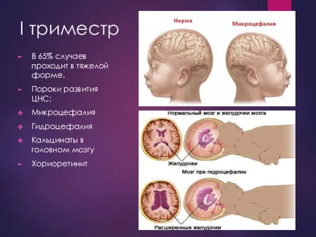 I триместр В 65% случаев проходит в тяжелой форме. Пороки развития ЦНС: Микроцефалия