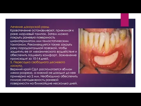 Лечение донорской раны. Кровотечение останавливают, прижимая к ране марлевый тампон.