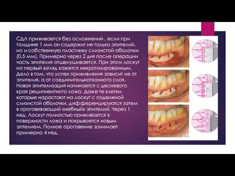 СДЛ приживается без осложнений , если при толщине 1 мм