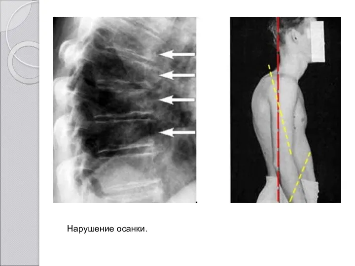 Нарушение осанки.
