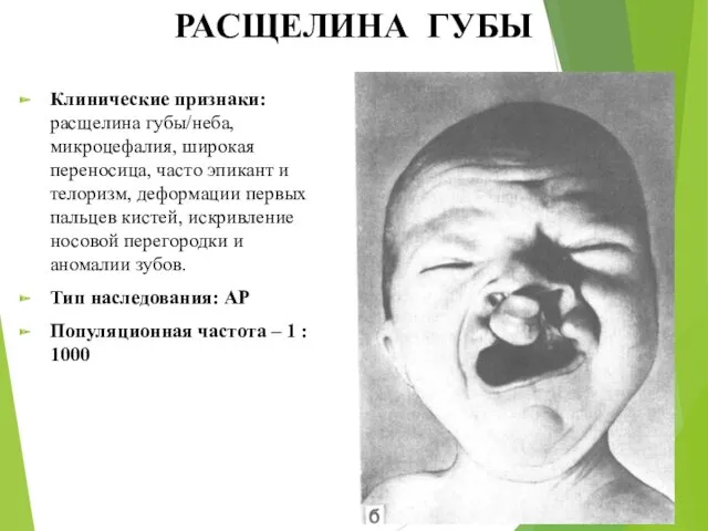 РАСЩЕЛИНА ГУБЫ Клинические признаки: расщелина губы/неба, микроцефалия, широкая переносица, часто