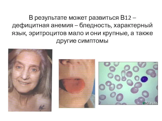 В результате может развиться В12 –дефицитная анемия – бледность, характерный язык, эритроцитов мало