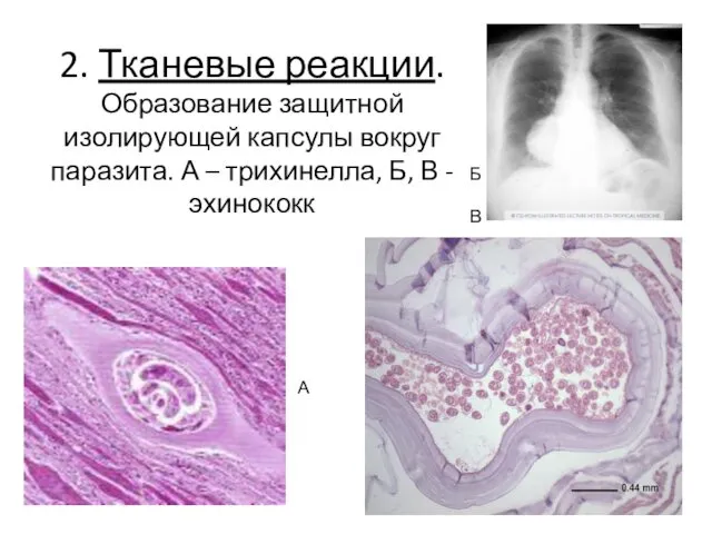 2. Тканевые реакции. Образование защитной изолирующей капсулы вокруг паразита. А – трихинелла, Б,