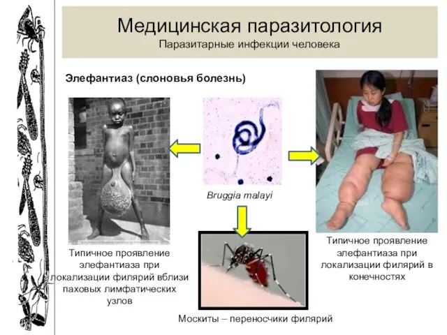 Медицинская паразитология Паразитарные инфекции человека Элефантиаз (слоновья болезнь) Bruggia malayi