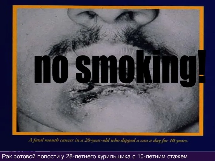 Рак ротовой полости у 28-летнего курильщика с 10-летним стажем no smoking!