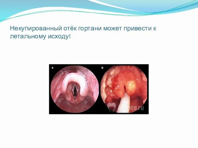 Некупированный отёк гортани может привести к летальному исходу!