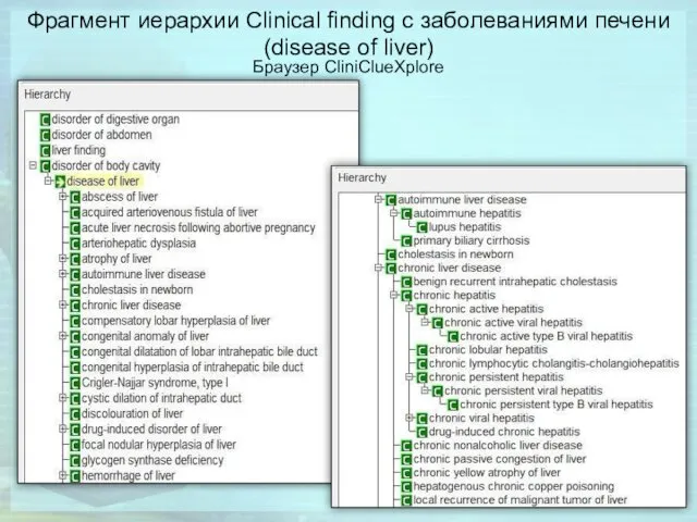 Фрагмент иерархии Clinical finding с заболеваниями печени (disease of liver) Браузер CliniClueXplore