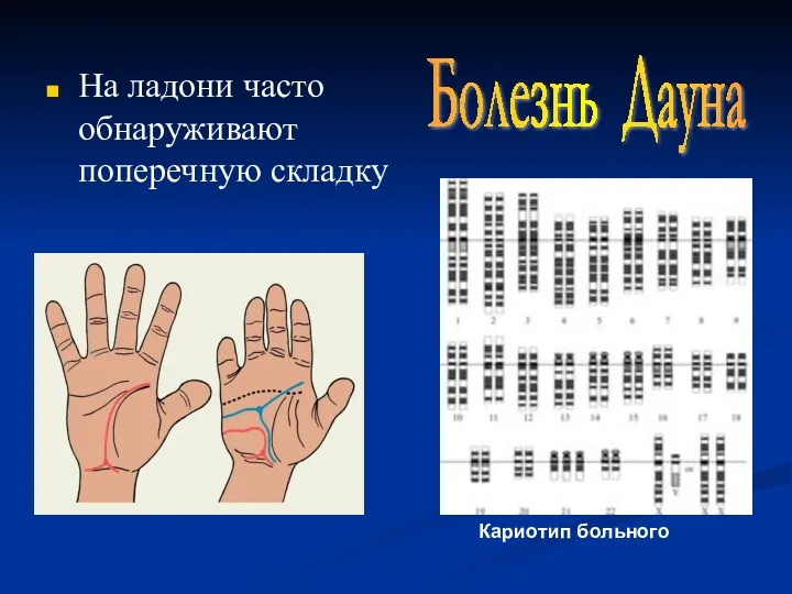 На ладони часто обнаруживают поперечную складку Болезнь Дауна Кариотип больного