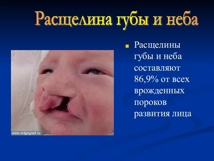 Расщелины губы и неба составляют 86,9% от всех врожденных пороков развития лица Расщелина губы и неба
