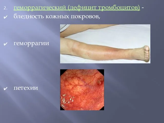 геморрагический (дефицит тромбоцитов) - бледность кожных покровов, геморрагии петехии