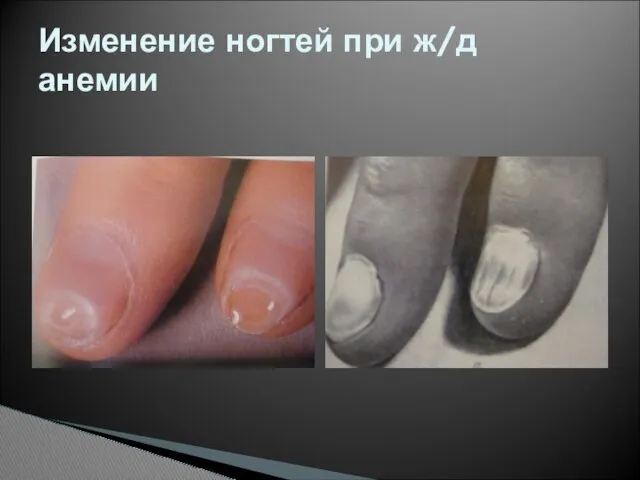 Изменение ногтей при ж/д анемии