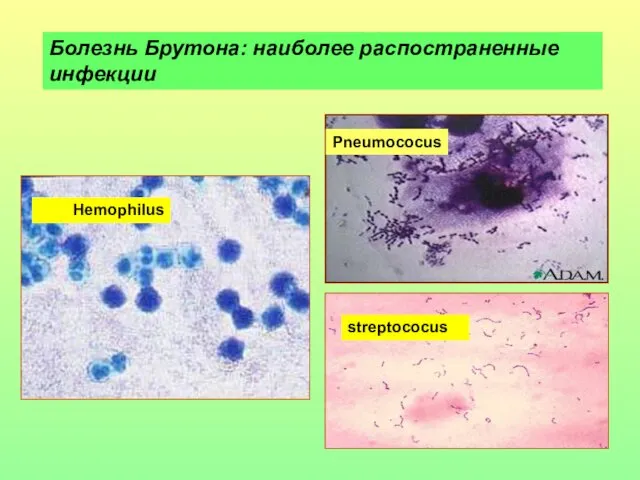 Pneumococus streptococus Hemophilus Болезнь Брутона: наиболее распостраненные инфекции