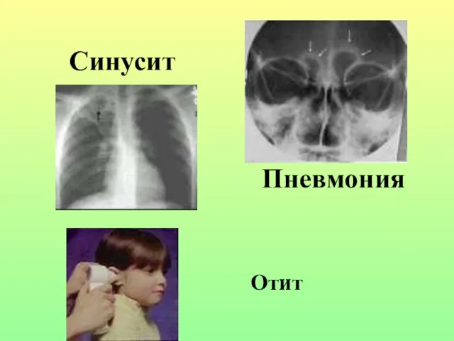 Отит Пневмония Синусит