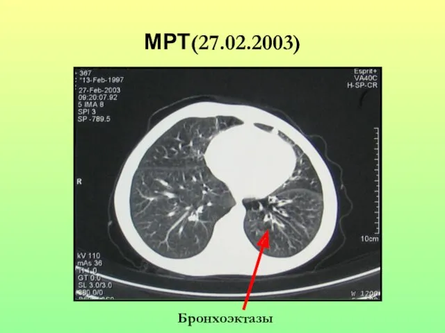 МРТ(27.02.2003) Бронхоэктазы