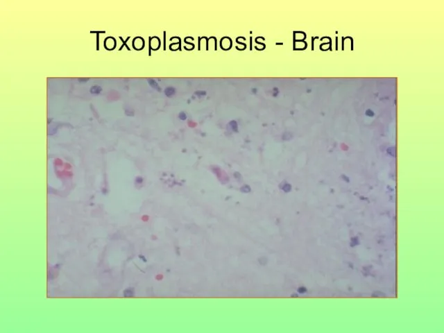 Toxoplasmosis - Brain