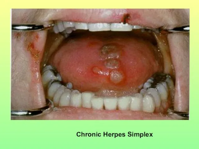 Chronic Herpes Simplex
