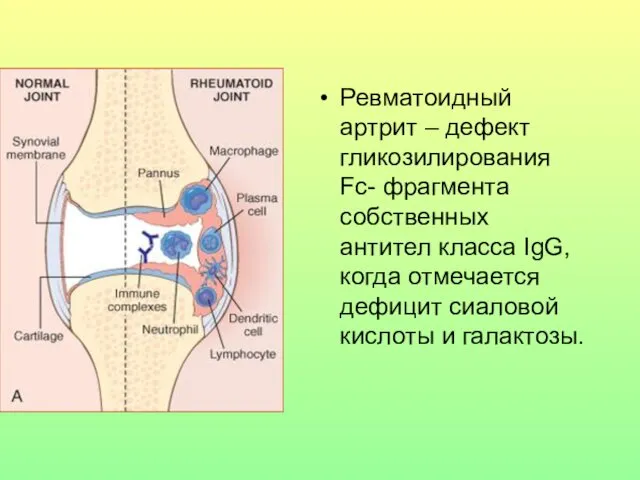 Ревматоидный артрит – дефект гликозилирования Fc- фрагмента собственных антител класса