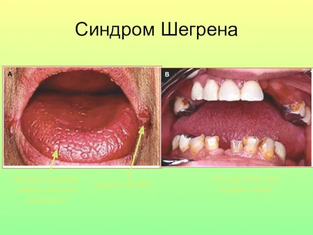 atrophic papillae, deeply fissured epithelium angular cheilitis missing teeth and multiple caries Синдром Шегрена