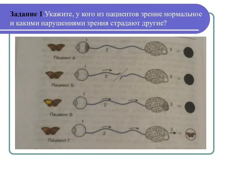 Задание 1.Укажите, у кого из пациентов зрение нормальное и какими нарушениями зрения страдают другие?