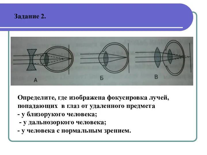 Определите, где изображена фокусировка лучей, попадающих в глаз от удаленного