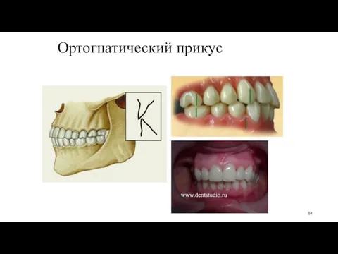 Ортогнатический прикус