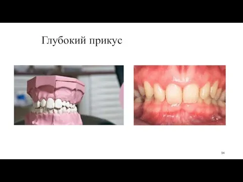 Глубокий прикус