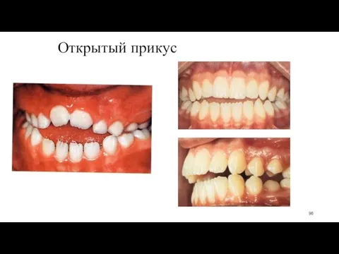 Открытый прикус