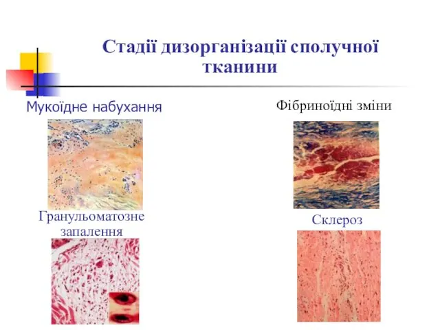 Мукоїдне набухання Стадії дизорганізації сполучної тканини Фібриноїдні зміни Гранульоматозне запалення Склероз