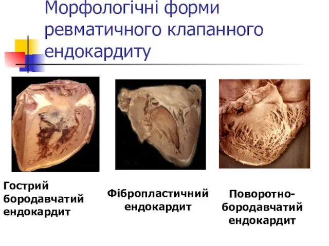 Морфологічні форми ревматичного клапанного ендокардиту Гострий бородавчатий ендокардит Фібропластичний ендокардит Поворотно- бородавчатий ендокардит