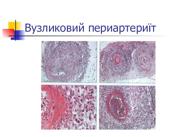 Вузликовий периартериїт