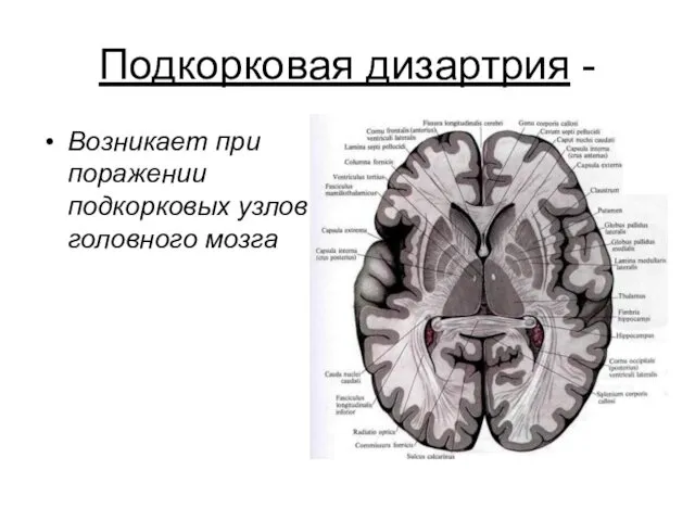 Подкорковая дизартрия - Возникает при поражении подкорковых узлов головного мозга