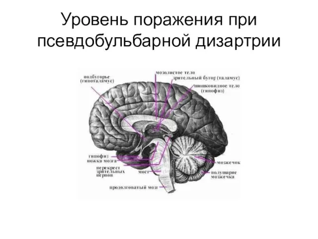 Уровень поражения при псевдобульбарной дизартрии